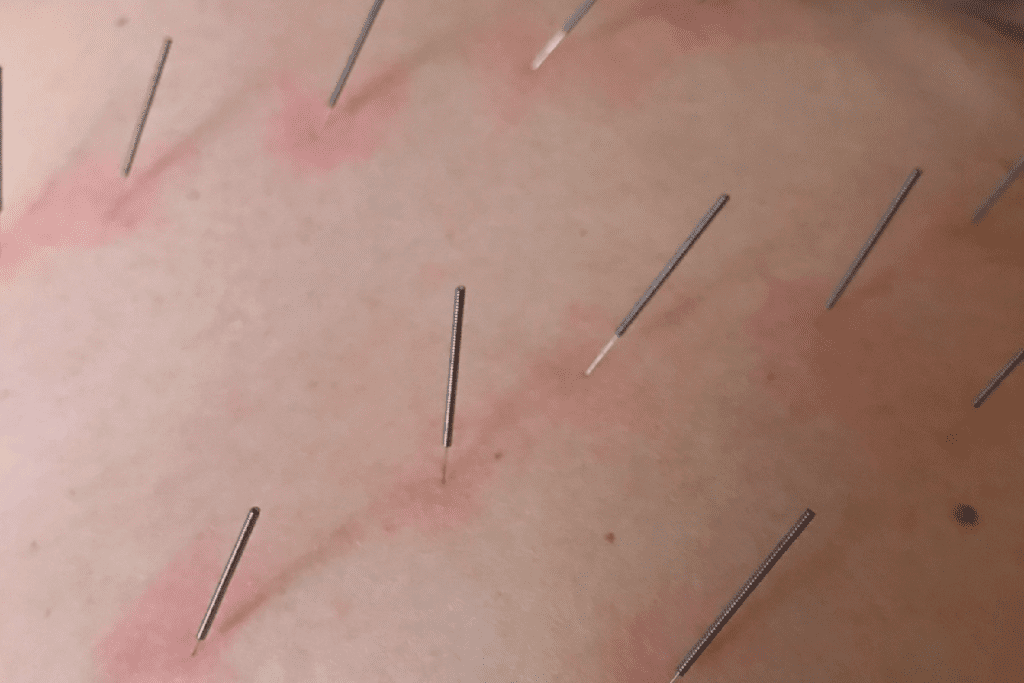 A close up of many needles on the skin