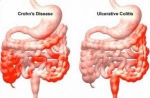 A picture of the same type of bowel in both of its stages.