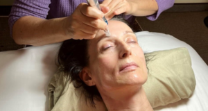 Microneedling Session in Sabrina Kirkland Acupuncture